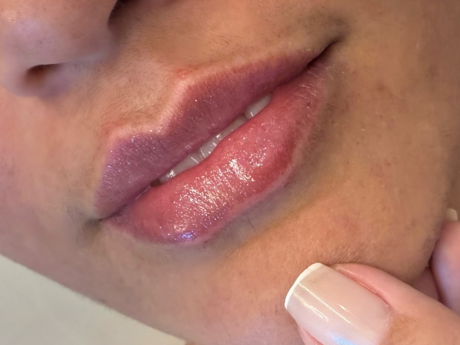 Resultado Contorno 2 - Antes e Depois