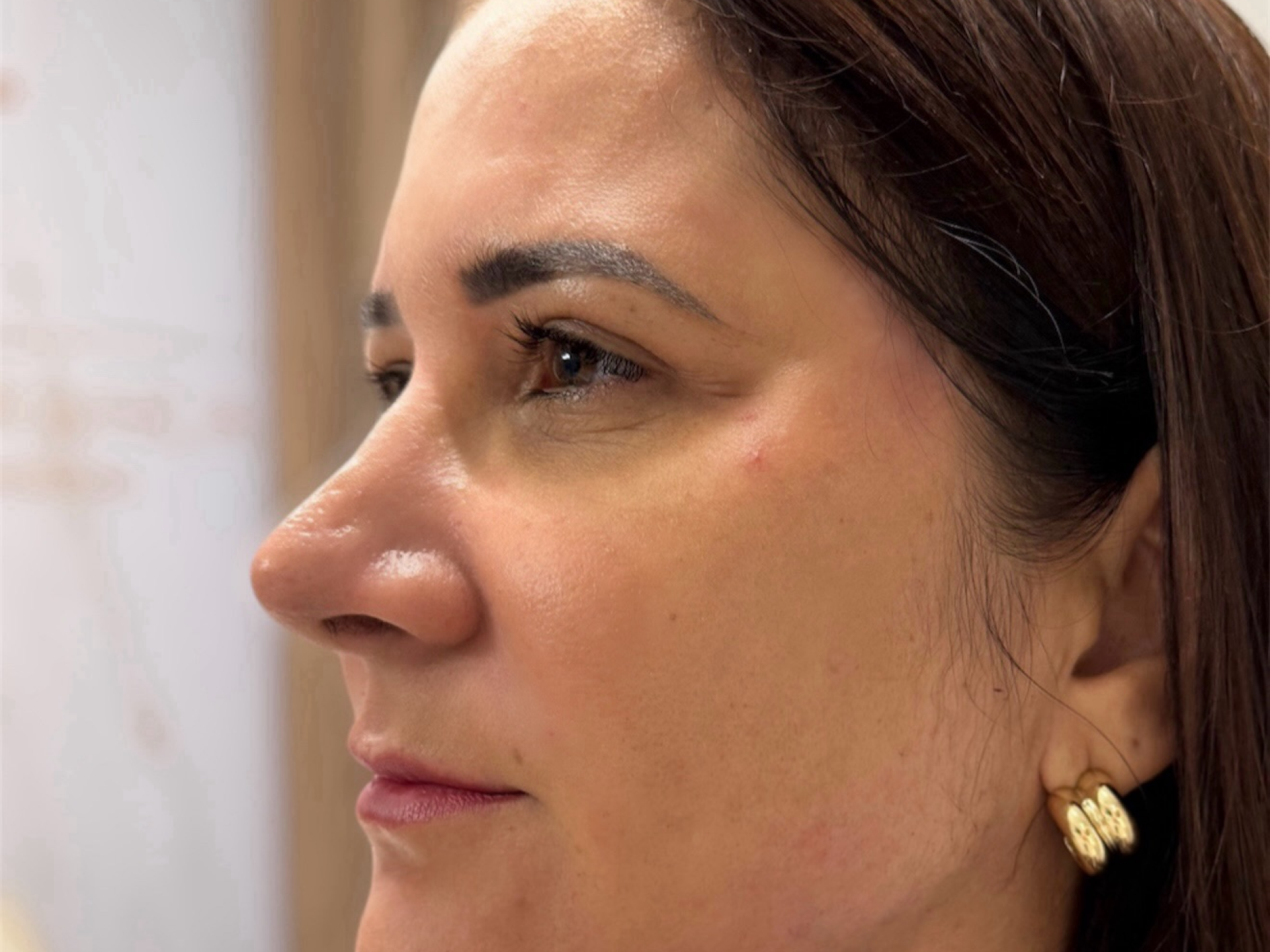 Depois Dra. Fernanda