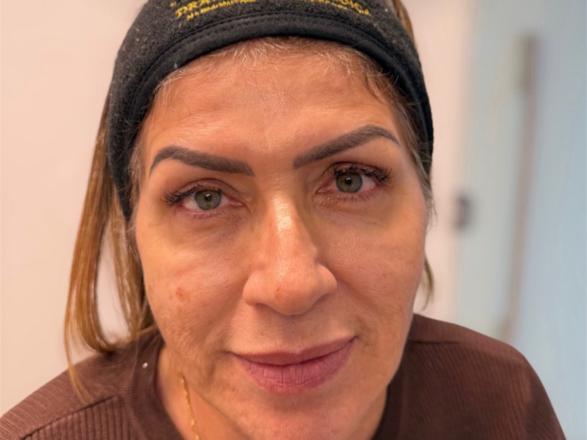 Depois Dra. Fernanda