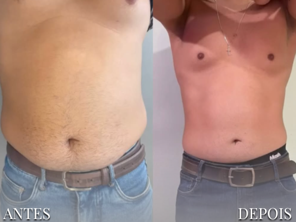 Resultado Dra. Fernanda 14