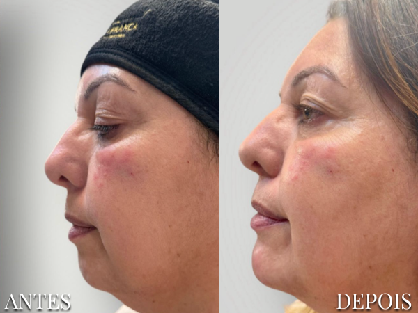 Resultado Dra. Fernanda 6